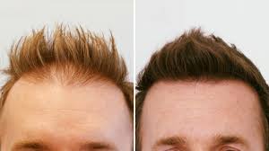Low Cost Hair Transplant in Raipur