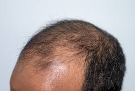Male Pattern Baldness Hair Transplant in Raipur