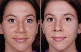 Melasma Removal in Raipur