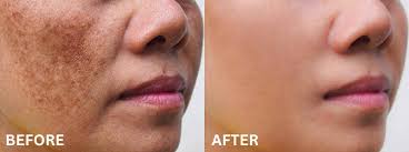 Melasma Treatment in Raipur