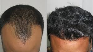 Natural Hair Transplant Results in Raipur