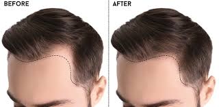 Natural Hair Transplant Results in Raipur