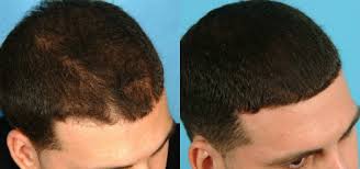 PRP vs Hair Transplant Benefits in Raipur
