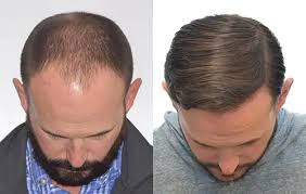 Permanent Hair Transplant Results in Raipur