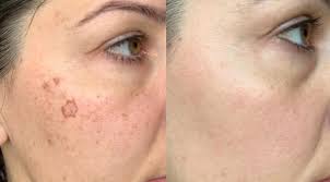 Pigmentation Removal in Raipur