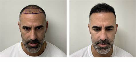 Real Hair Transplant Results in Raipur