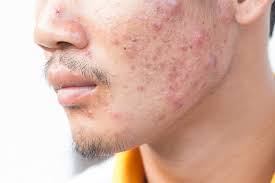 Remove Acne Marks Naturally