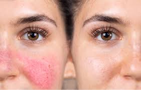 Rosacea Treatment in Raipur