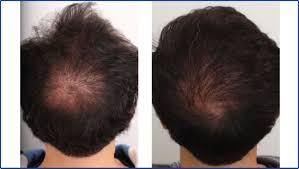 Scalp Hair Transplant in Raipur