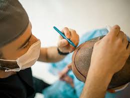 Schedule Hair Transplant in Raipur