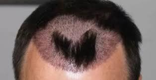 Side Effects of Hair Transplant in Raipur