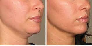 Skin Tightening Treatment in Raipur