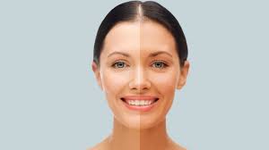 Skin Whitening Treatment in Raipur