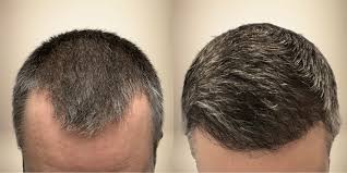 Thread Hair Therapy in Raipur
