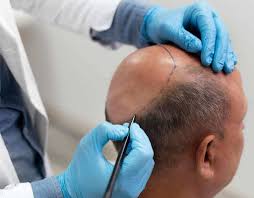 Top Rated Hair Transplant in Raipur