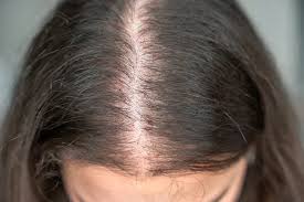 Treatment for Thinning Hair in Raipur