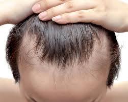 Weak Hairline Treatment in Raipur
