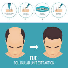 What is FUE Hair Transplant