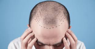 What to Expect from Hair Transplant in Raipur