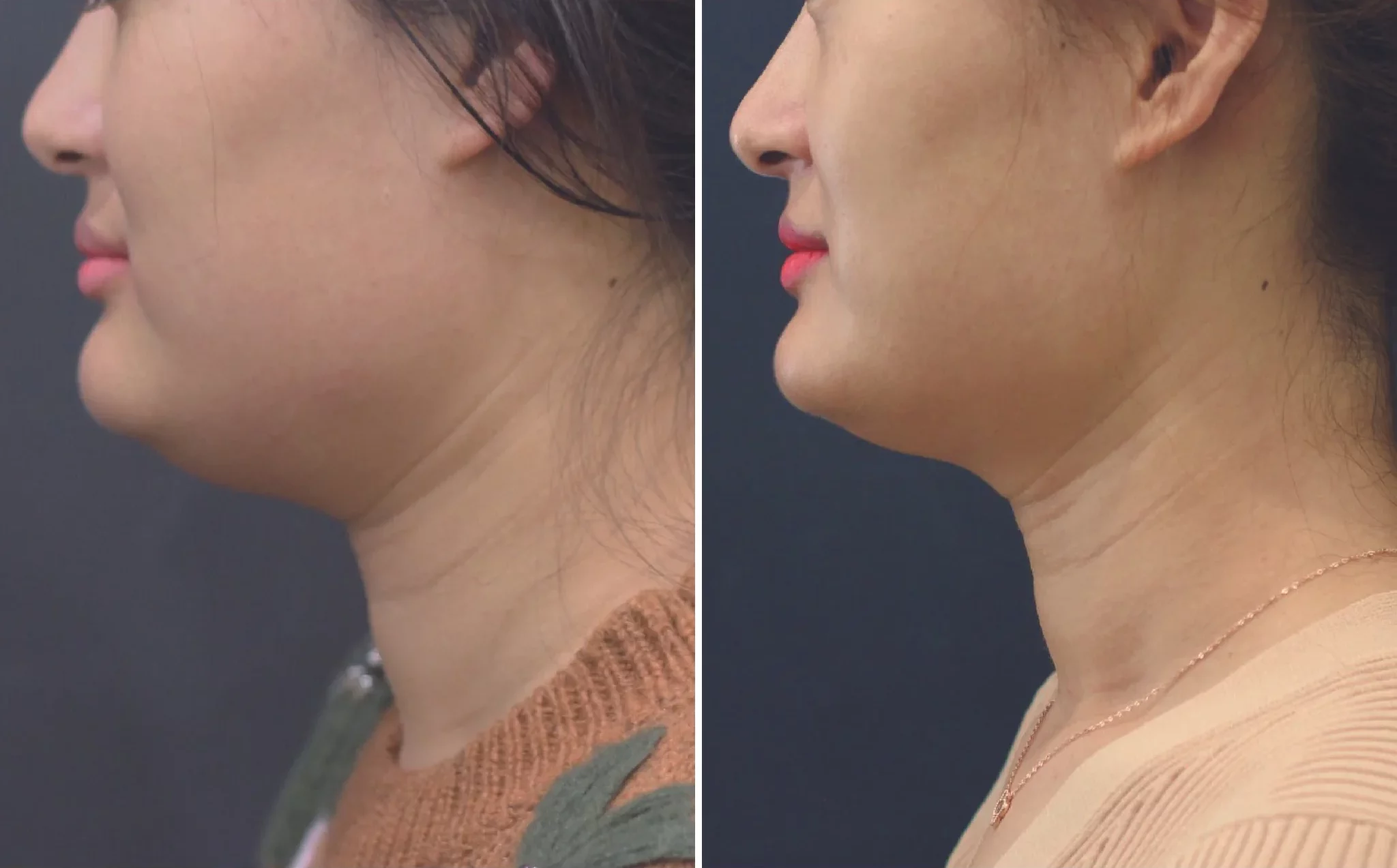 HIFU for double chin