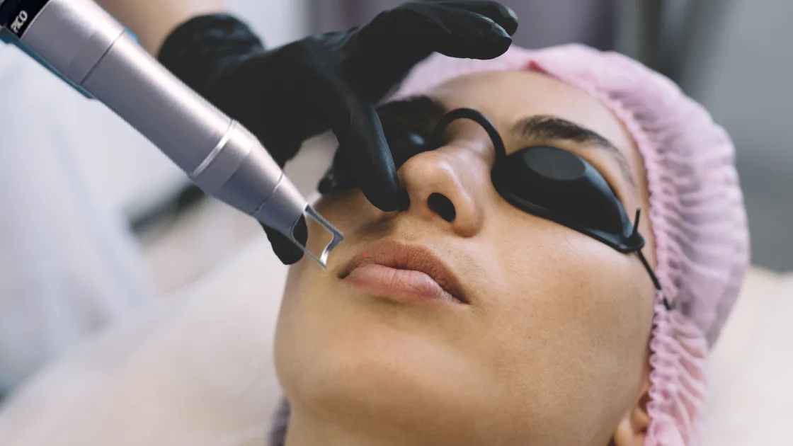 How Pico laser has revolutionised the pigmentation reduction standards