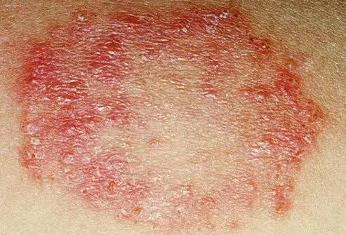 Is fungal infection on the wall the same as human fungal infection?