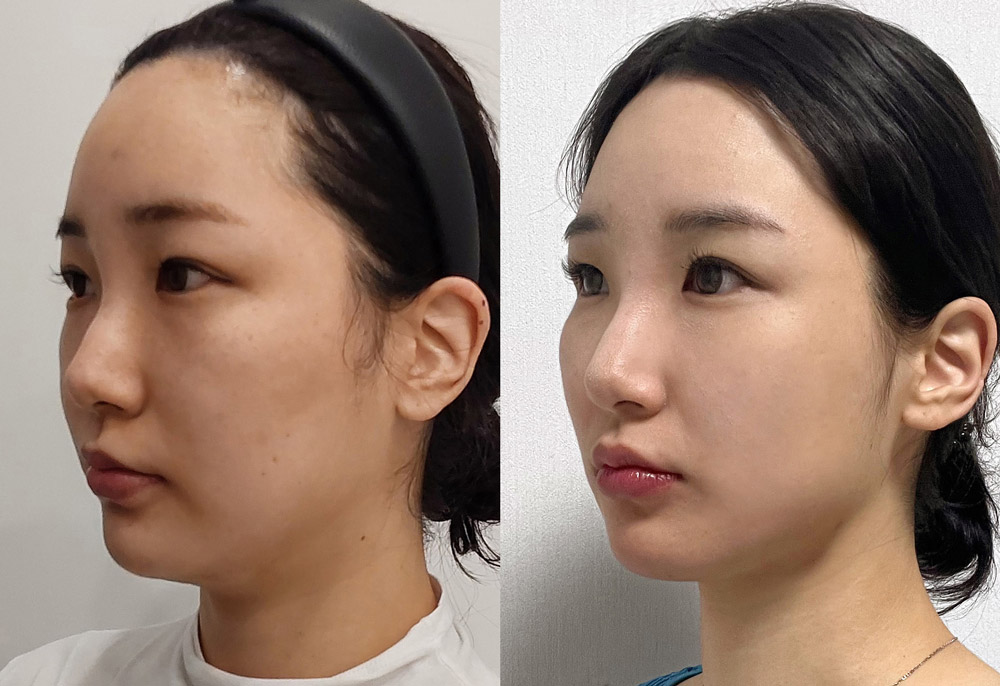 Korean Threadlifting techniques