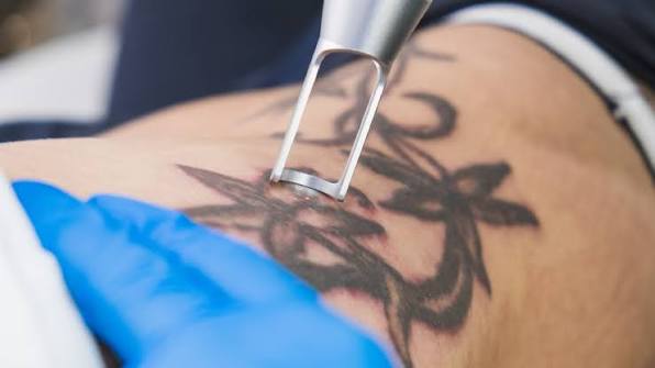 Tattoo removal - all you need to know