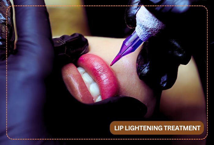 The new craze for lasear lip lightneing - how safe it is