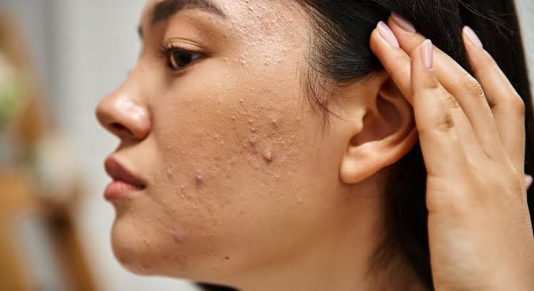 Active Acne Laser