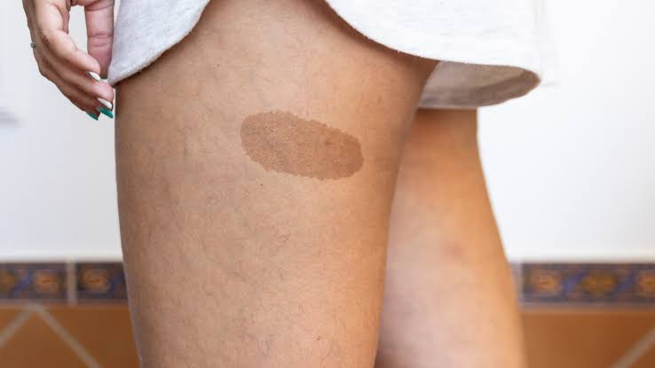 Birth Mark Removal