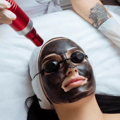 Carbon Toning (Hollywood Facial)