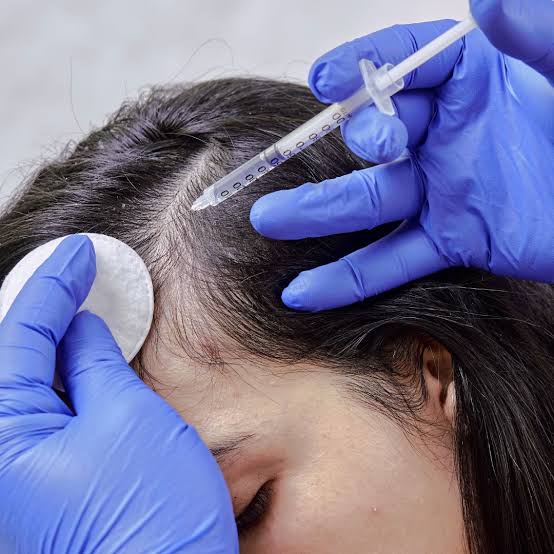 Hair growth with Mesotherapy
