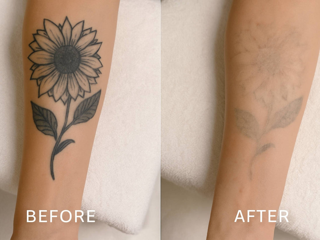 Tattoo Removal