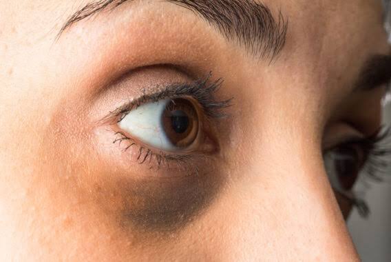 Will dark circles go with filter treatment