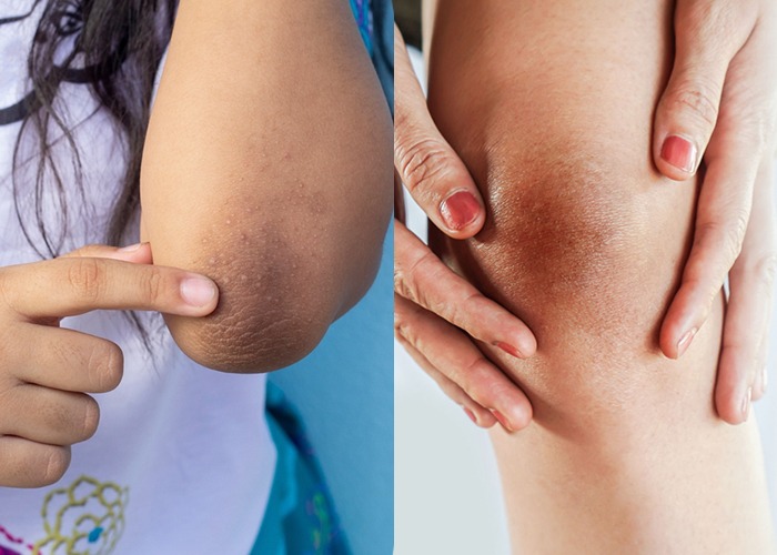 Knee and Elbow Polishing Treatment
