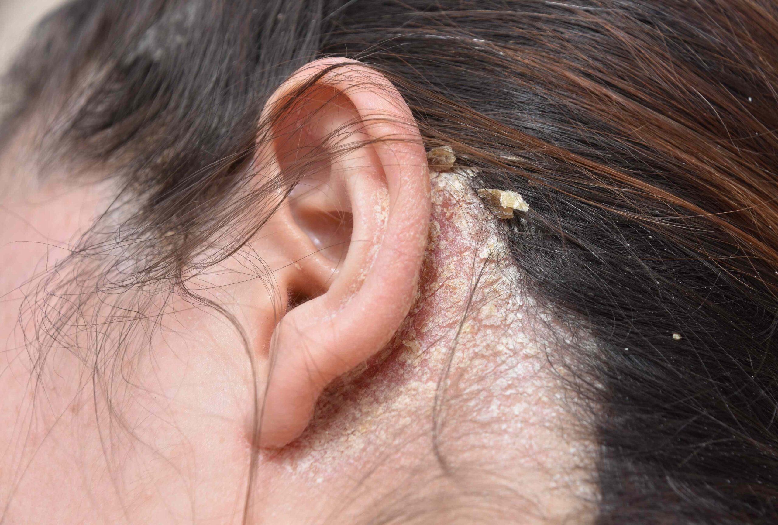 Seborrheic Dermatitis In Nagpur