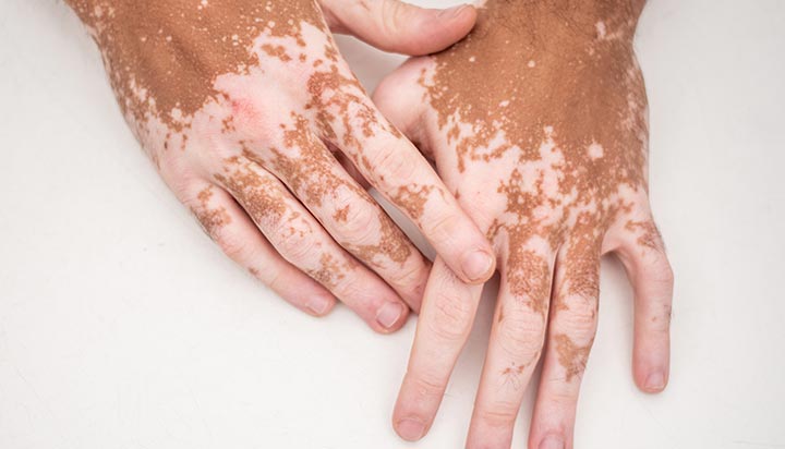 Vitiligo Treatment In Nagpur